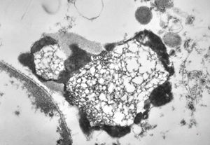 M,46y. | prostate - residual lysosome